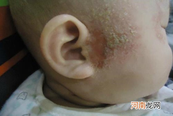 婴儿湿疹图片 宝宝湿疹的初期症状图片