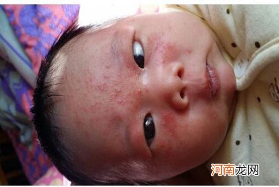 婴儿湿疹图片 宝宝湿疹的初期症状图片