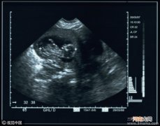 B超检查对胎儿有影响吗