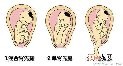 胎位roa可以顺产吗