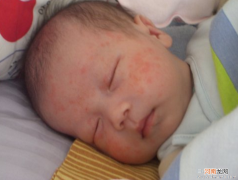 宝宝经常长湿疹父母如何预防过敏