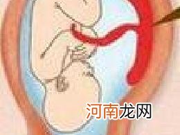 胎盘早剥的预防