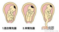 loa胎位比roa容易顺产