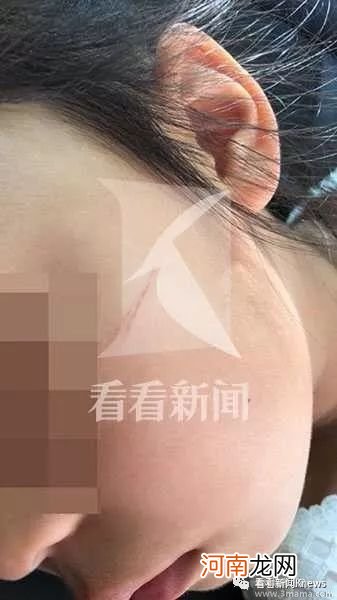 幼儿园女教师用笔划伤四岁女童脸部