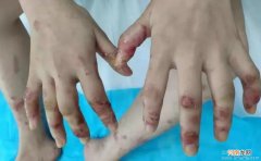 手足口病疱疹的治疗方法