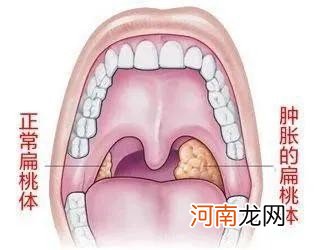 一夜之间喉咙痛咽口水都痛怎么回事 咽喉肿痛症状