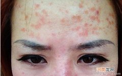 染发导致的皮肤过敏症状是什么
