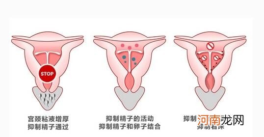 上环注意事项须知 放置节育环需注意哪些事项