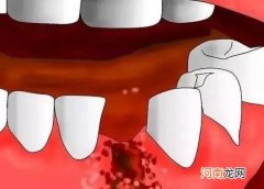 拔完牙多久可以镶牙 拔牙后多久可以镶牙