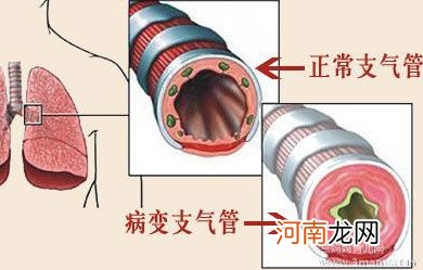 慢性支气管炎应当以预防为主