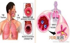 支气管哮喘的治疗与预防