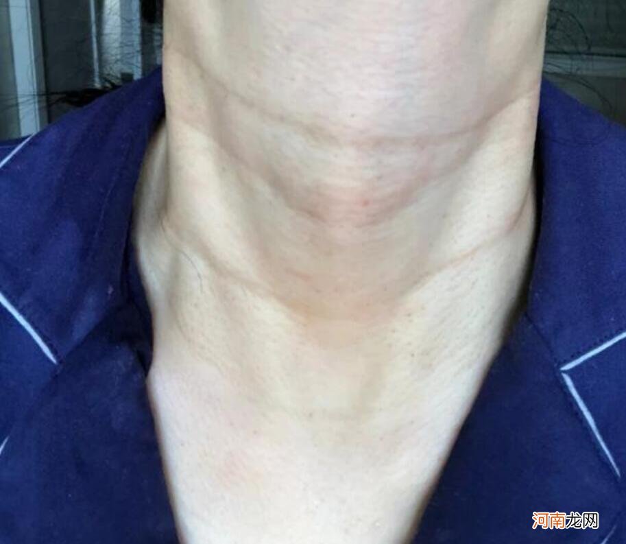 颈纹的护理方法有哪些？