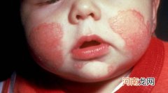 婴儿湿疹症状