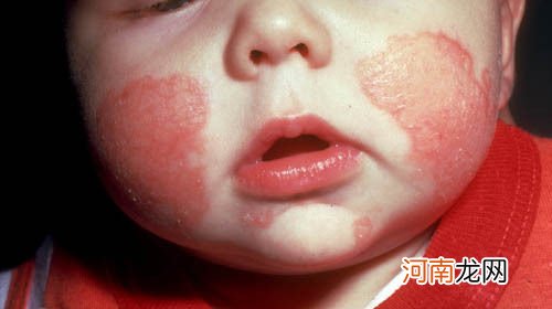 婴儿湿疹症状