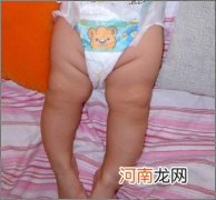 婴儿腿内弯就是佝偻病吗