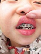 生活中哪些坏习惯会容易引起孩子牙齿受损