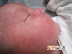 如何预防宝宝夏季皮肤疾病