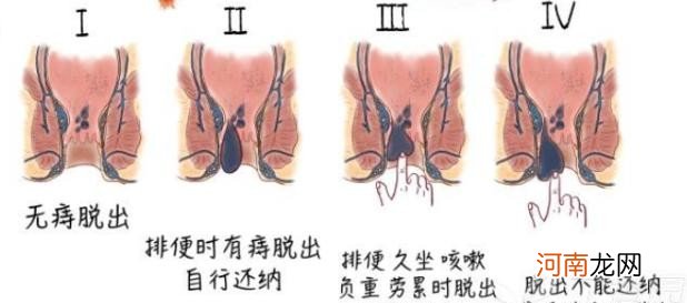 痔疮如何进行保守治疗呢 痔疮的最佳自愈方法