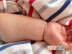 4妙招预防宝宝皮肤过敏