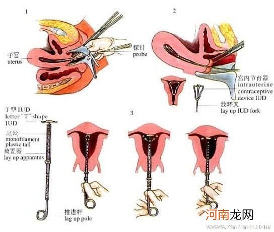 新妈妈产后避孕以上环为佳