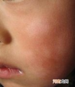 孩子脸上长白斑是怎么回事 儿童皮肤有白斑怎么办
