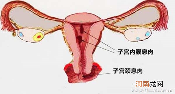 宫颈息肉对于生育的影响