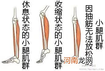 孕期抽筋的原因及如何防治