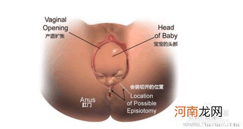 顺产侧切伤口要怎么护理