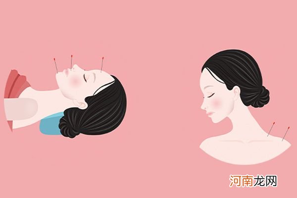 针灸减肥扎哪些部位 减肥针灸哪些部位图片