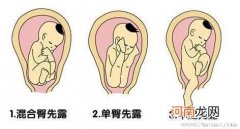 孕晚期胎儿臀位怎么办