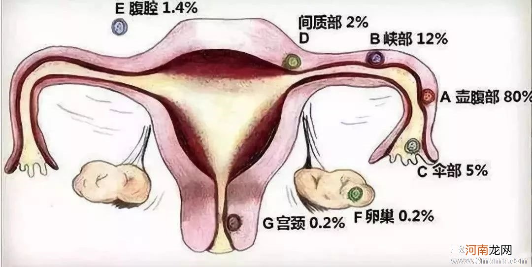 这3种女性最容易宫外孕，第2种最严重