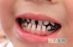 支招：孩子乳牙提早脱落的处理方法