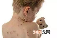 冬春季宝宝发热出皮疹警惕是水痘