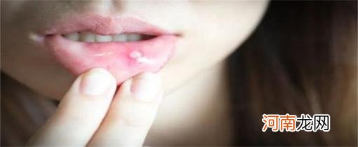 口腔溃疡疼痛难忍怎么快速缓解？优质