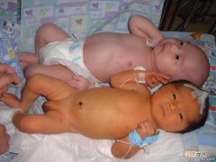 新生儿黄疸分两种 母乳喂养也能引起黄疸