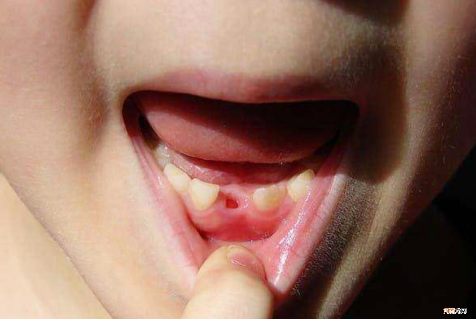 孩子脱落的乳牙能“救命”？英国科学家：可能发挥着神奇作用