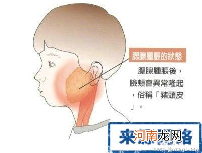 小儿流行性腮腺炎会发热吗