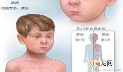 宝宝传染病：宝宝得了麻疹怎么办