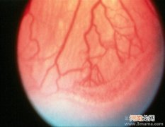 治疗早产儿视网膜病变最佳时间