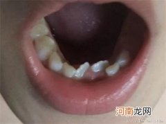 孩子恒牙矫形12岁比较适宜