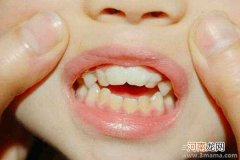 如何才能让宝宝有一口漂亮牙齿