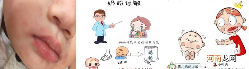 宝宝奶粉过敏的症状 宝宝为什么会奶粉过敏