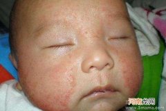 新生儿脸上的湿疹应对法
