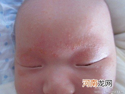 宝宝患湿疹的五大常见原因