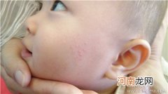 宝宝湿疹怎么办 宝宝湿疹如何护理