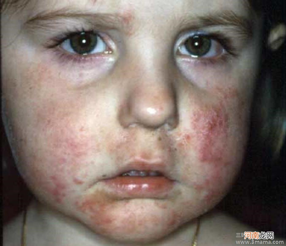 宝宝4种出疹性皮肤疾病的特征