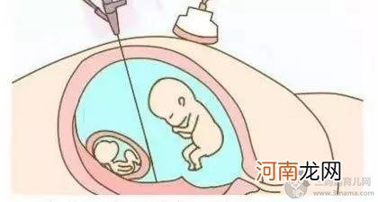多胎妊娠应该如何决择？一定要做减胎手术吗？ - 早产