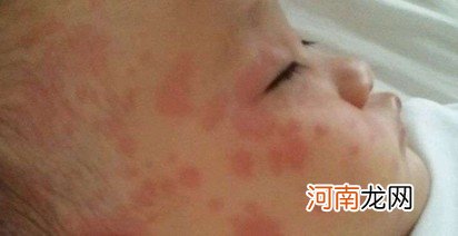 婴儿脸上长疙瘩怎么办 婴儿脸上长红疙瘩怎么回事