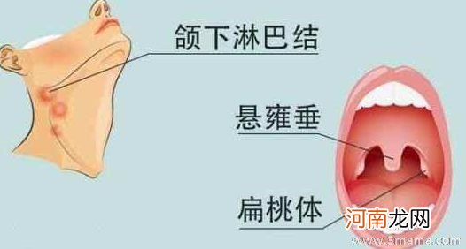 炎症反复发作扁桃体切or留？