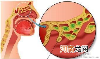 鼻炎影响孩子发育